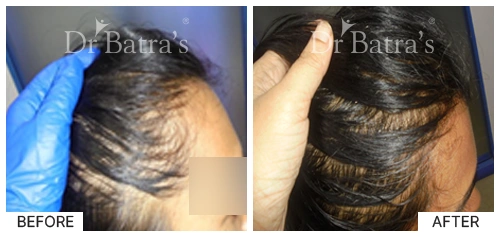 Hair Falling Treatment